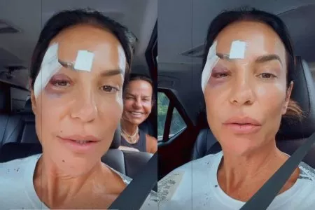 Com olho roxo, Ivete recebe alta de hospital em Salvador e explica quadro de saúde