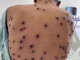 Lesões na pele causadas pelo Mpox, infecção provocada pelo vírus monkeypox, pertencente ao mesmo grupo da varíola. Foto: Reprodução