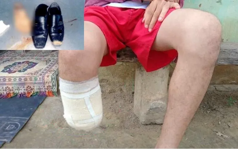 Homem é condenado após amputar o pé para receber seguro de R$ 1,5 milhão